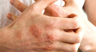 Karaciğer hastalığının ciltteki 8 belirtisine dikkat