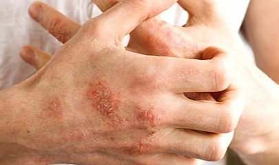 Karaciğer hastalığının ciltteki 8 belirtisine dikkat
