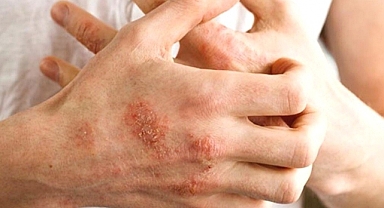 Sonbaharda alerjik egzamaya dikkat