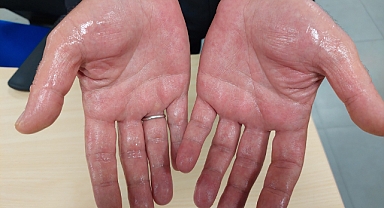 Aşırı terlemeden kurtulmak artık çok kolay