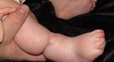 Amniyotik bant sendromu olan bebekler ameliyat ile tedavi edilebiliyor