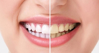 Diş beyazlatma ile çay ve kahvenin olumsuz etkisine son