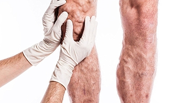 Venaseal yöntemi ile varislerden ameliyatsız kurtulmak mümkün