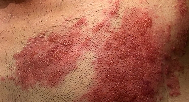 Zayıflayan bağışıklık zona vakalarını artırdı