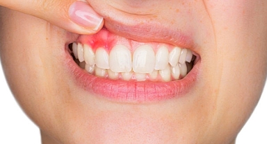 Diş çürükleri ağız içi kanserine neden olabilir