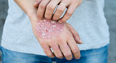 "Yılda 100 milyon kişi uyuz tehdidiyle karşı karşıya kalıyor"