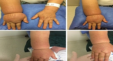 Lenfödem hastalarının dikkat etmesi gerekenler