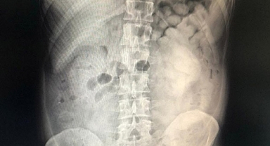 Şüpheli yolcunun midesinden 800 gram eroin çıktı