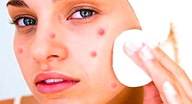 Tedavi edilmeyen akneler skara’ya dönüşüyor