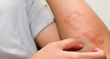 Besin alerjisi mi? Besin intoleransı mı?