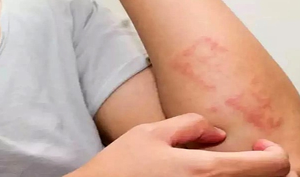 Besin alerjisi mi? Besin intoleransı mı?