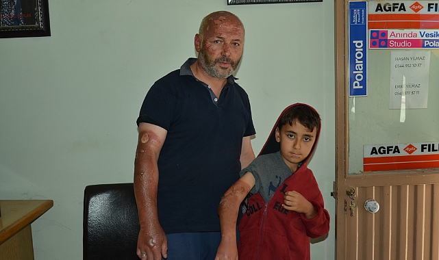 Piknik alanında yakılan çöpler patladı: 1'i çocuk 2 yaralı