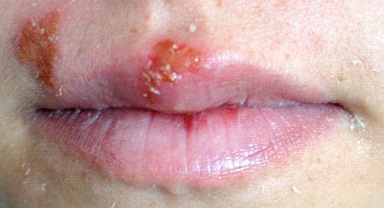 Uçuk deyip geçmeyin