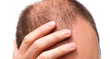 Dünya genelinde saç dökülmesiyle mücadele kişi sayısı açıklandı