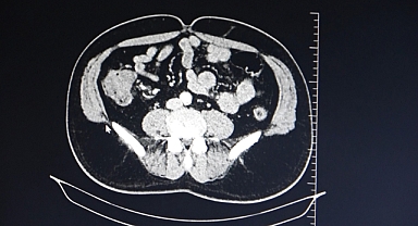 Uzmanlar vatandaşları kolon kanserine karşı uyardı
