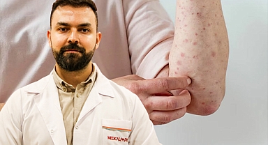 Uyuz vakaları arttı! Uzman uyardı