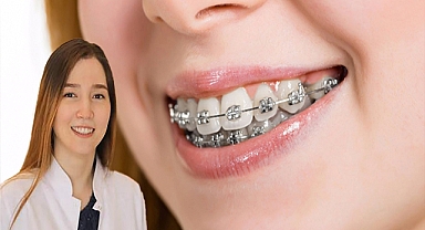 Uzmanından diş teli tedavisi ile ilgili uyarılar!