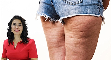 Uzmanından selülit ve çatlakları önlemek için öneriler