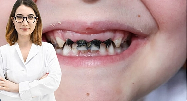 “Biberon çürüğü” bebeklerde konuşmayı geciktiriyor