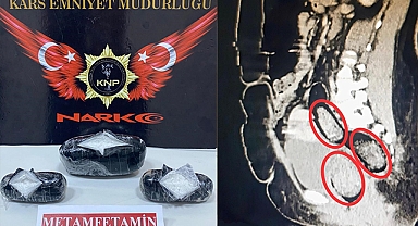 İranlı kadının bağırsaklarından uyuşturucu çıktı