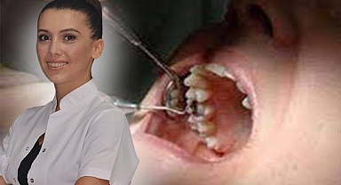 Süt dişleri arasında boşluğa dikkat, dişlerde çapraşıklığa neden oluyor