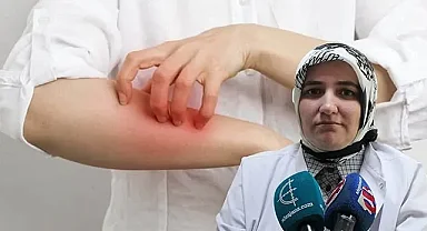 Toplu yaşam alanlarına dikkat! Uyuz hastalığı riski yüksek