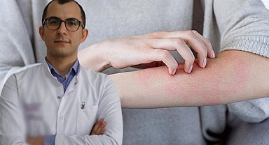 Uzmanı uyardı, uyuz tedavisinde ilaçlar yetersiz kalıyor