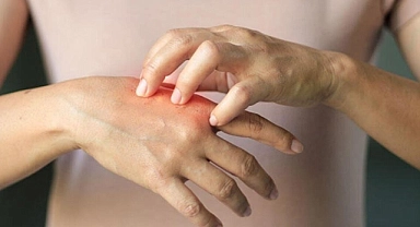 Baharda sık görülen 5 cilt hastalığı