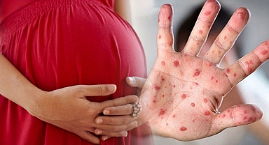 Maymun çiçeği, enfekte anneden bebeğine geçebilir mi? Uzmanı açıkladı