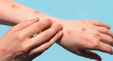 Sağlık Bakanlığı 'maymun çiçeği rehberi' yayımladı