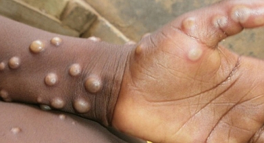 Türkiye'de maymun çiçeği görüldü mü? Bakanlıktan açıklama