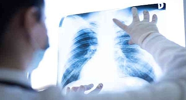 Bu belirtilere dikkat! Akciğer kanserinin habercisi olabilir