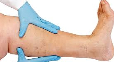 Hangi aylar varis tedavisi için en uygun dönem? Uzmanı açıkladı