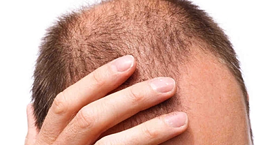 Saçları dökülenler dikkat! Uzmanından kesim çözüm